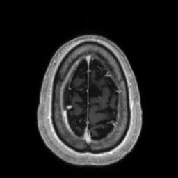 File:Cerebral amyloid angiopathy (Radiopaedia 29129-29518 Axial T1 C+ 134).jpg