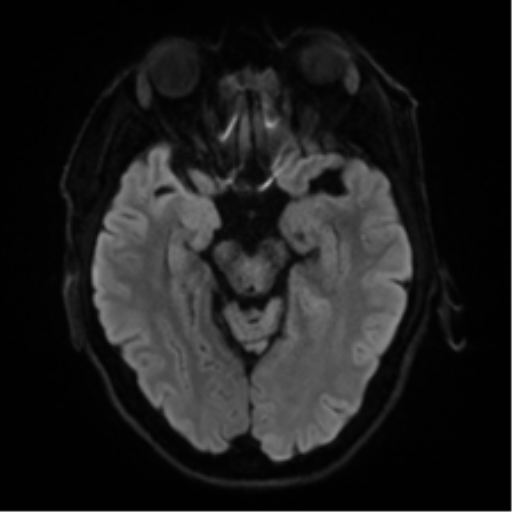 File:Cerebral amyloid angiopathy (Radiopaedia 46082-50433 Axial DWI 37).png