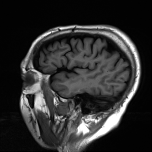 File:Cerebral amyloid angiopathy (Radiopaedia 46082-50433 Sagittal T1 23).png