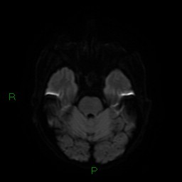 Cerebral amyloid angiopathy (Radiopaedia 77506-89664 Axial DWI 10).jpg