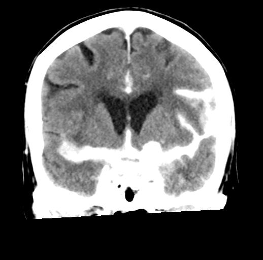 File:Cerebral aneurysm with rupture (Radiopaedia 29933-30460 Coronal non-contrast 15).jpg