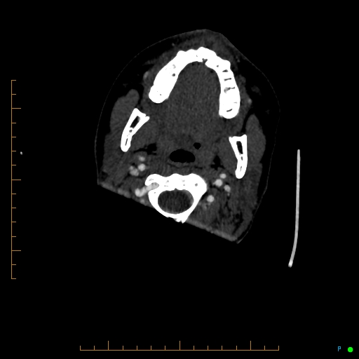 Cerebral arteriovenous malformation (AVM) (Radiopaedia 78162-90706 Axial CTA 12).jpg
