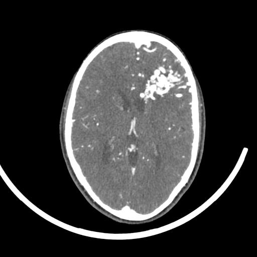 Cerebral arteriovenous malformation (Radiopaedia 29531-30031 E 27).jpg