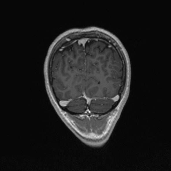 Cerebral arteriovenous malformation (Radiopaedia 30198-30813 F 50).jpg