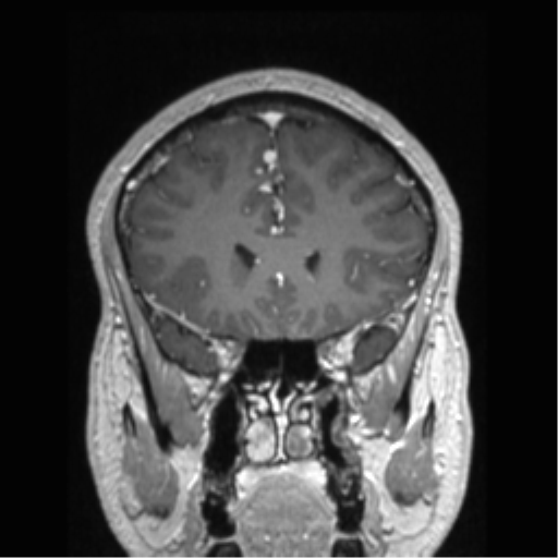 Cerebral arteriovenous malformation (Radiopaedia 39259-41506 Coronal T1 C+ 67).png