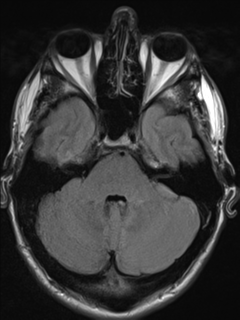 File:Cerebral arteriovenous malformation (Radiopaedia 55798-62372 Axial FLAIR 6).png