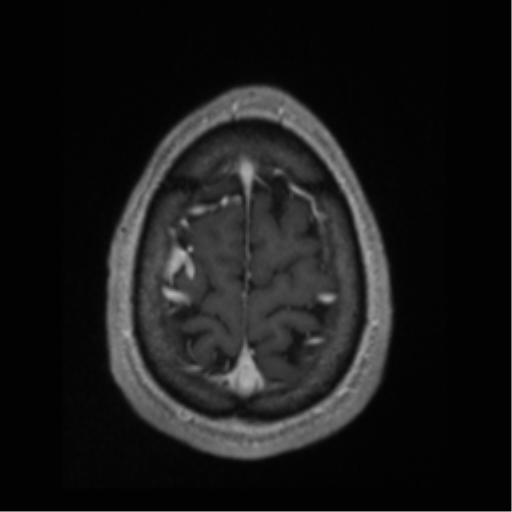 Cerebral arteriovenous malformation (Radiopaedia 55798-62372 Axial T1 C+ 69).png