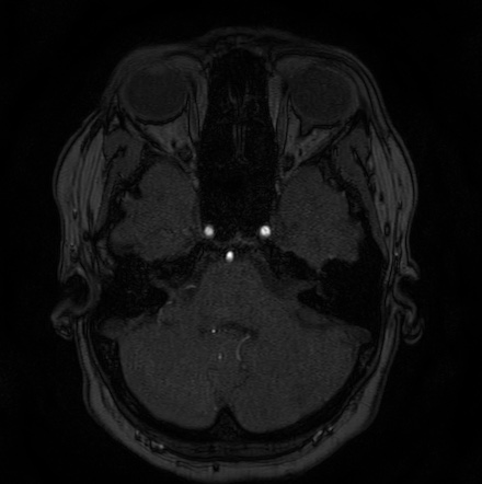 Cerebral arteriovenous malformation (Radiopaedia 74411-85654 Axial MRA 21).jpg