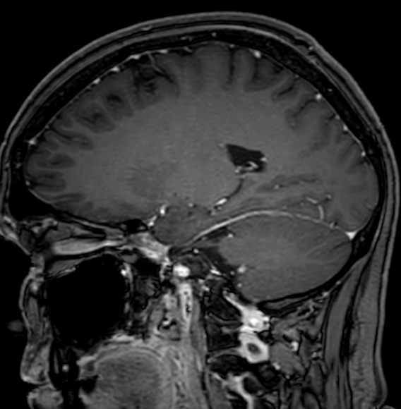 Cerebral arteriovenous malformation (Radiopaedia 74411-85746 Sagittal T1 C+ 47).jpg