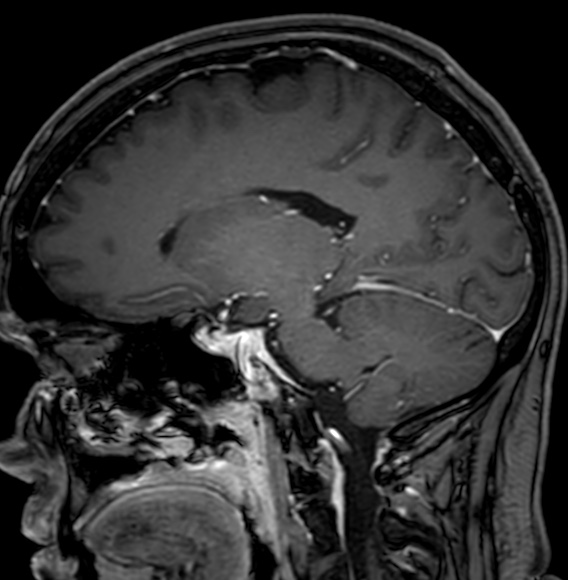 Cerebral arteriovenous malformation (Radiopaedia 74411-85746 Sagittal T1 C+ 52).jpg