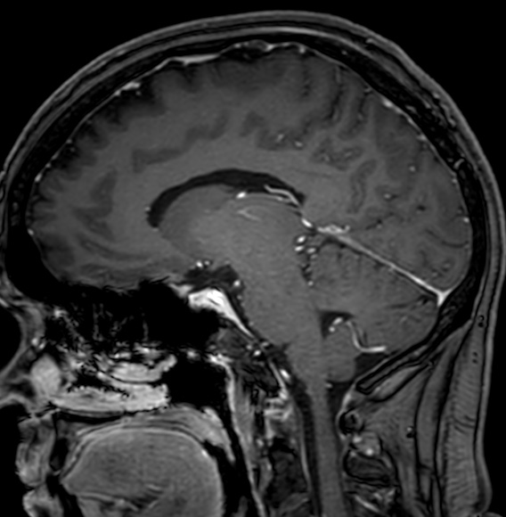 Cerebral arteriovenous malformation (Radiopaedia 74411-85746 Sagittal T1 C+ 56).jpg