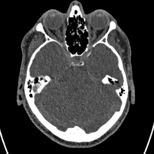 Cerebral arteriovenous malformation (Radiopaedia 78188-90746 Axial non-contrast 55).jpg