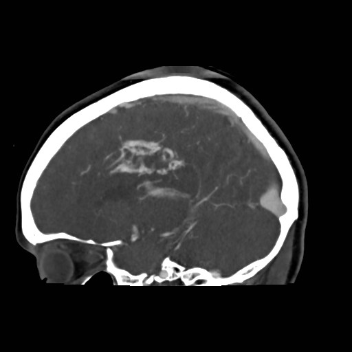 File:Cerebral arteriovenous malformation (Radiopaedia 79677-92888 C 29).jpg