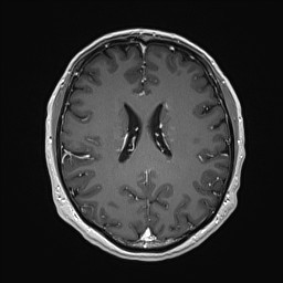 Cerebral arteriovenous malformation (Radiopaedia 84015-99245 Axial T1 C+ 96).jpg