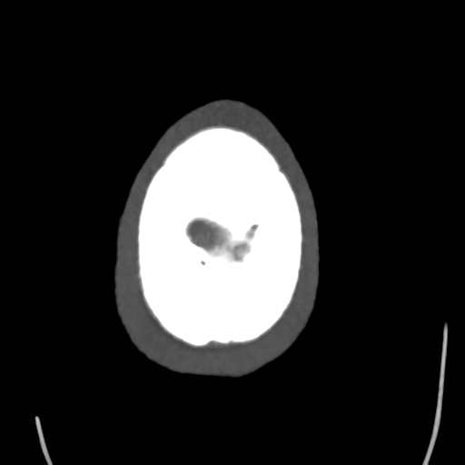 Cerebral arteriovenous malformation (Spetzler-Martin grade 2) (Radiopaedia 41262-44076 E 52).png