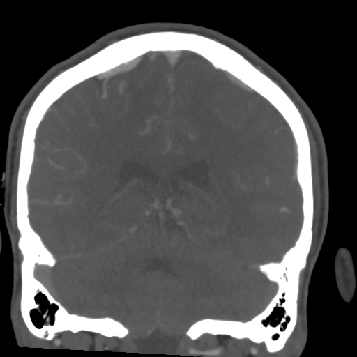 Cerebral arteriovenous malformation (Spetzler-Martin grade 2) (Radiopaedia 41262-44076 F 43).png