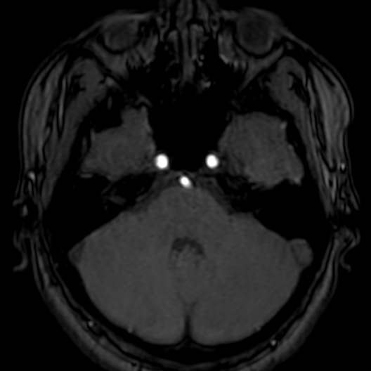 Cerebral arteriovenous malformation at posterior body of corpus callosum (Radiopaedia 74111-84925 Axial MRA 45).jpg