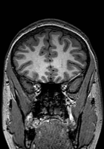 Cerebral arteriovenous malformation at posterior body of corpus callosum (Radiopaedia 74111-84925 Coronal T1 75).jpg