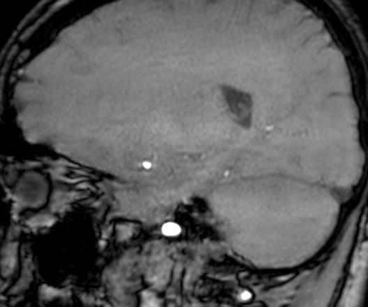 Cerebral arteriovenous malformation at posterior body of corpus callosum (Radiopaedia 74111-84925 J 261).jpg
