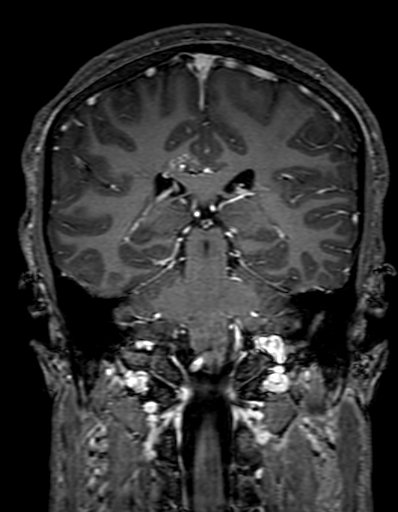 Cerebral arteriovenous malformation at posterior body of corpus callosum (Radiopaedia 74111-84925 K 228).jpg
