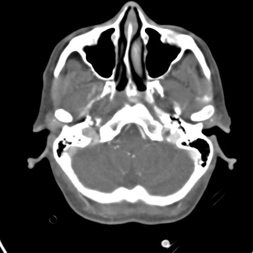 Cerebral arteriovenous malformation with hemorrhage (Radiopaedia 28773-29073 A 45).jpg