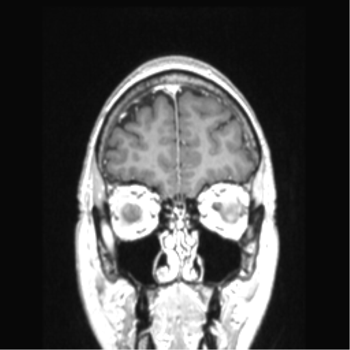 Cerebral arteriovenous malformation with hemorrhage (Radiopaedia 34422-35737 Coronal T1 C+ 77).png