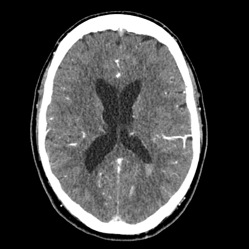 File:Cerebral arteriovenous malformation with lobar hemorrhage (Radiopaedia 35598-57216 A 36).jpg