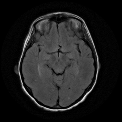 File:Cerebral autosomal dominant arteriopathy with subcortical infarcts and leukoencephalopathy (CADASIL) (Radiopaedia 41018-43763 Ax T2 Flair PROP 9).png