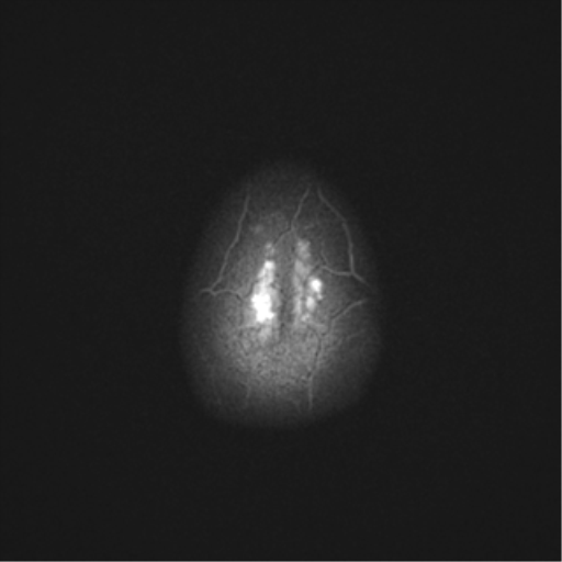 File:Cerebral cavernoma and development venous anomaly (Radiopaedia 37603-39482 Axial T2 23).png