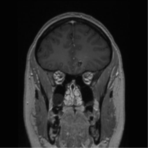 Cerebral cavernoma and development venous anomaly (Radiopaedia 37603-39482 Coronal T1 C+ 70).png