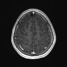 Cerebral cavernous venous malformation (Radiopaedia 70008-80021 Axial T1 C+ 79).jpg