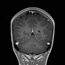 Cerebral cavernous venous malformation (Radiopaedia 70008-80021 Coronal T1 C+ 20).jpg