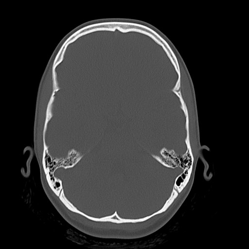 Cerebral cavernous venous malformation (Radiopaedia 70008-80022 Axial bone window 15).jpg