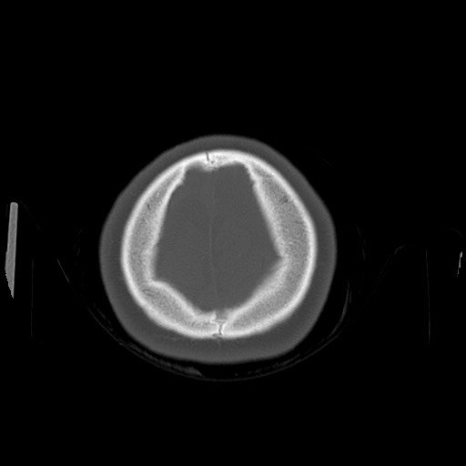 Cerebral cavernous venous malformation (Radiopaedia 70008-80022 Axial bone window 52).jpg