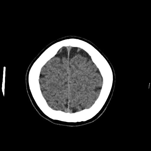 Cerebral cavernous venous malformation (Radiopaedia 70008-80022 Axial non-contrast 47).jpg
