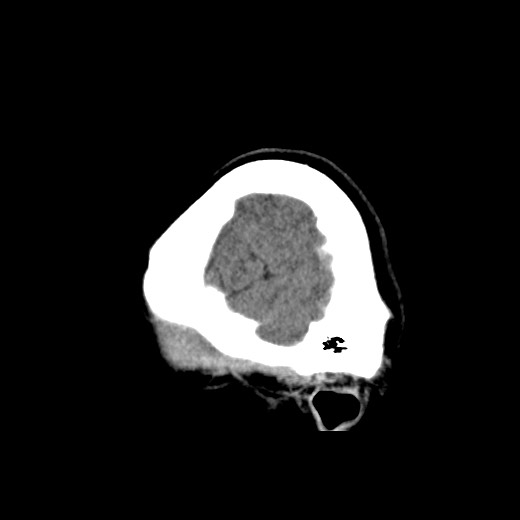 File:Cerebral cavernous venous malformation (Radiopaedia 70008-80022 C 4).jpg