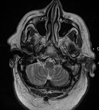 File:Cerebral embolic infarcts (embolic shower) (Radiopaedia 57395-64342 Axial T2 7).png