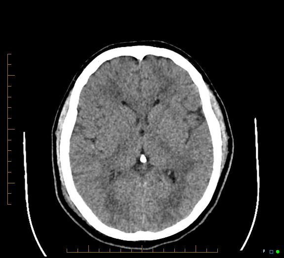 Cerebral fat embolism (Radiopaedia 85521-101220 Axial non-contrast 33).jpg