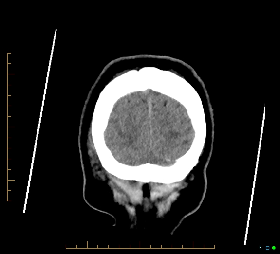 Cerebral fat embolism (Radiopaedia 85521-101220 Coronal non-contrast 57).jpg
