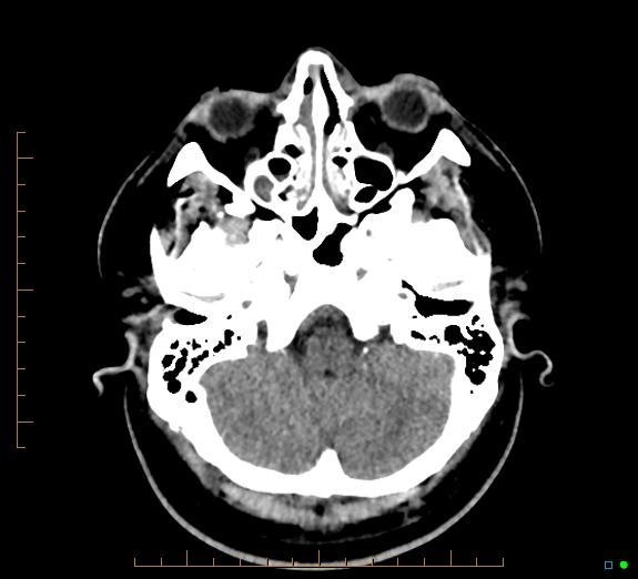 Cerebral fat embolism (Radiopaedia 85521-101224 Axial non-contrast 10).jpg