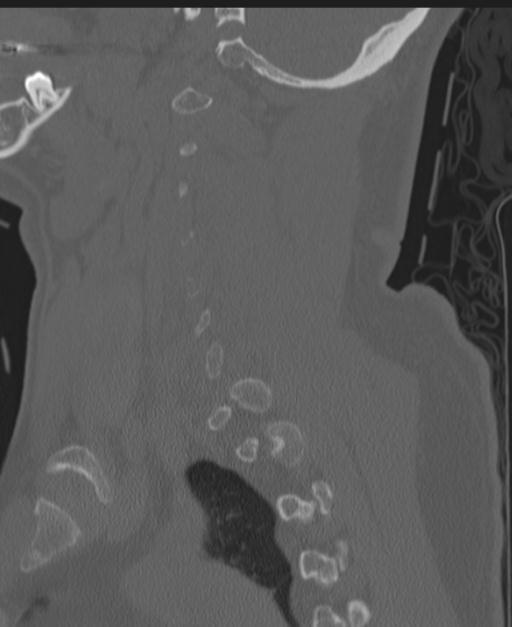 Cerebral hemorrhagic contusions and cervical spine fractures (Radiopaedia 32865-33841 Sagittal bone window 31).jpg