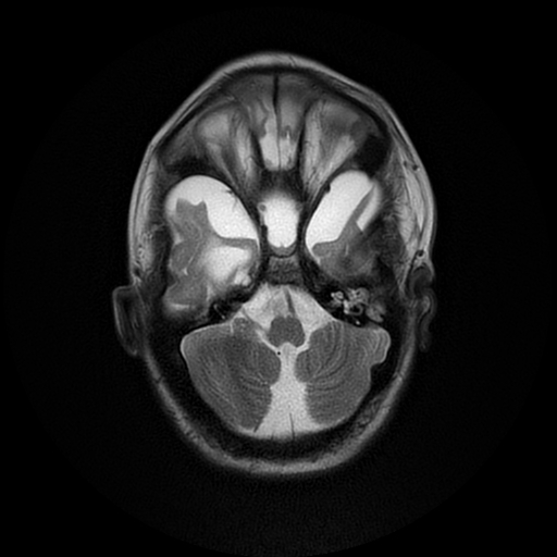 File:Cerebral manifestations of mucopolysaccharidosis type I (Radiopaedia 59171-66487 Axial T2 5).jpg