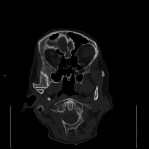Cerebral metastases - breast primary (Radiopaedia 77653-89857 Axial bone window 12).jpg