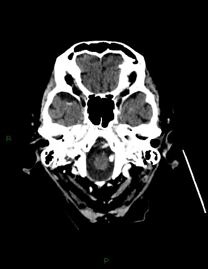 Cerebral metastases - ependymal and parenchymal (Radiopaedia 79877-93131 Axial C+ delayed 11).jpg