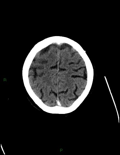 Cerebral metastases - ependymal and parenchymal (Radiopaedia 79877-93131 Axial C+ delayed 68).jpg