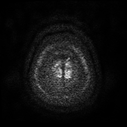 Cerebral metastases - melanoma (Radiopaedia 80972-94522 Axial DWI 61).jpg