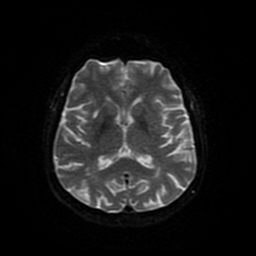 File:Cerebral metastases - melanoma (Radiopaedia 80972-94522 Axial DWI 81).jpg
