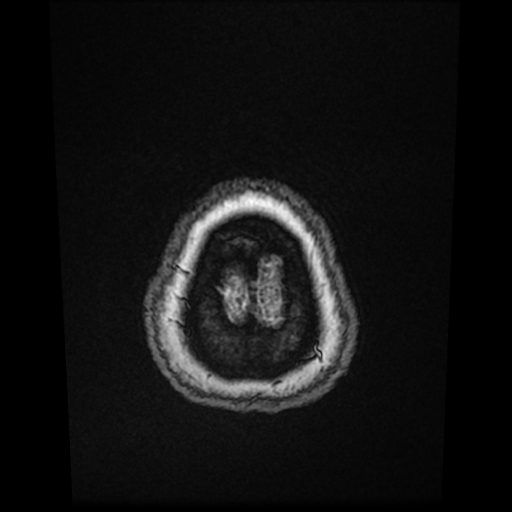 File:Cerebral metastases - melanoma (Radiopaedia 80972-94522 Axial T1 C+ 88).jpg