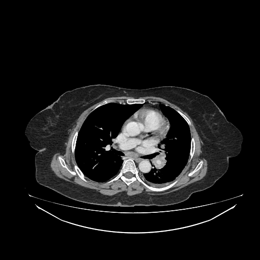 File:Cerebral metastases from lung cancer with amyloid angiopathy and cerebellopontine angle meningioma (Radiopaedia 74306-85223 A 26).jpg