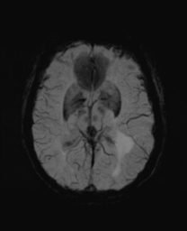 File:Cerebral metastasis (Radiopaedia 46744-51248 Axial SWI 16).png